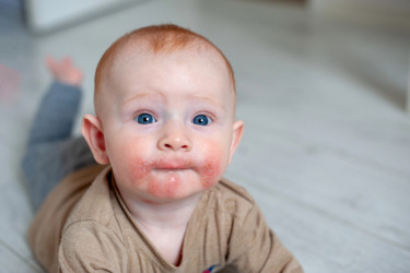 Ako zvládať atopickú dermatitídu u bábätka: 7 tipov, ktoré prinesú zlepšenie!